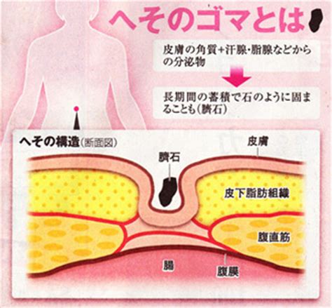 臍石除去|へそのごまの取り方は？正しい掃除方法や病気の注意。